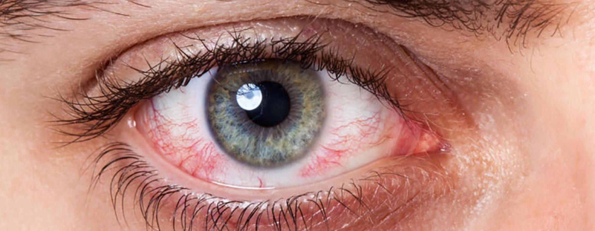 Alles over oogirritaties