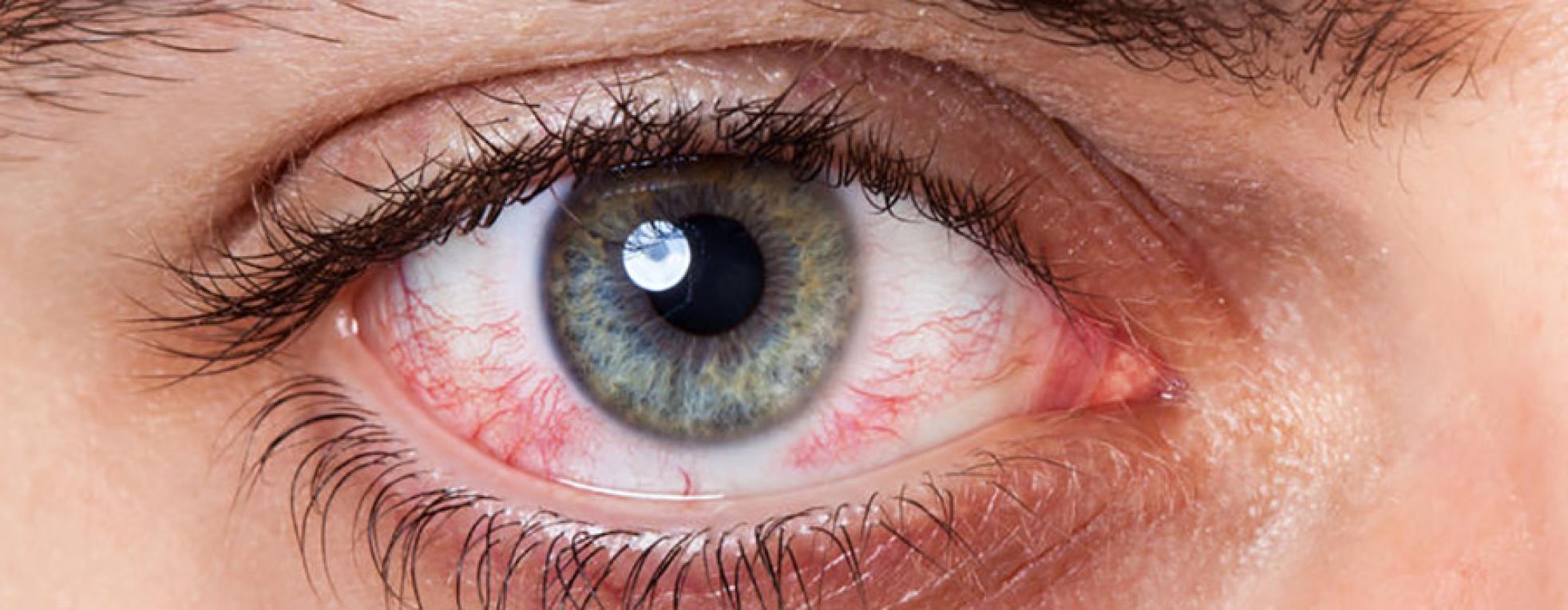 Alles over oogirritaties