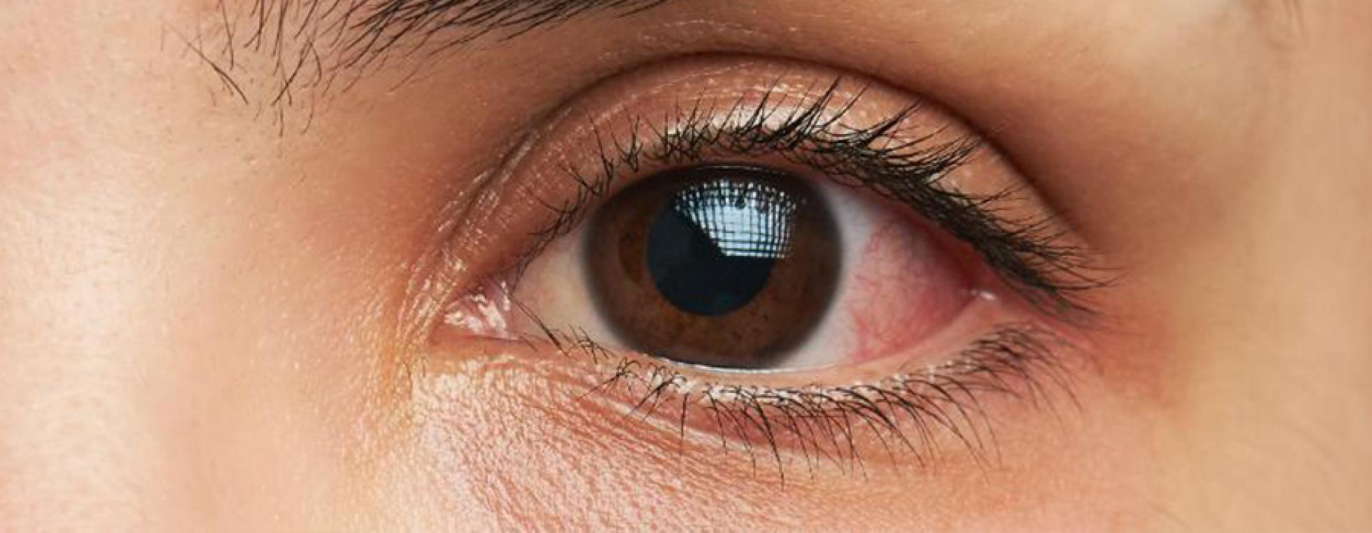 Was hilft gegen rote Augen?