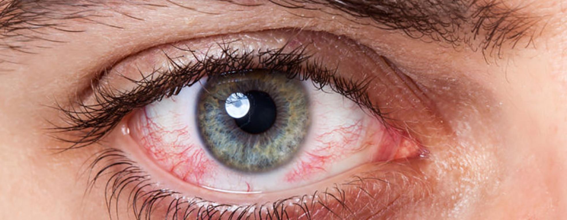 ¿Utilizar lentes de contacto provoca queratitis?