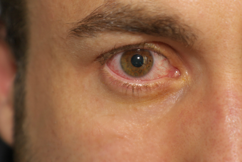 Augenentzündung