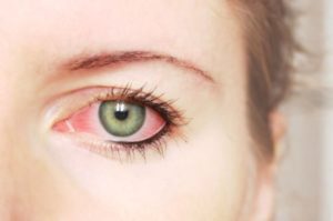 eye infection